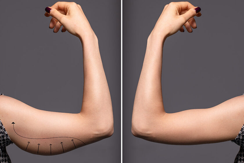 Woman arms with bat wings, comparison between before and after b